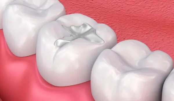 tratament plombă dentară