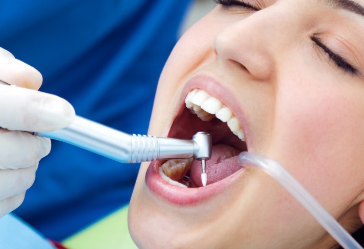 dental filling