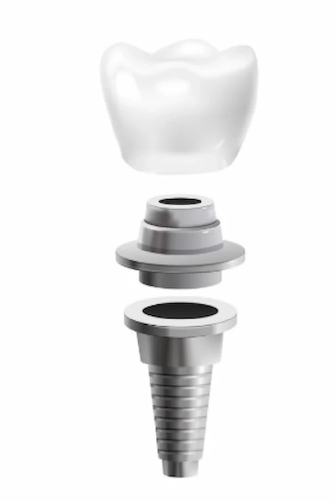 dental implant