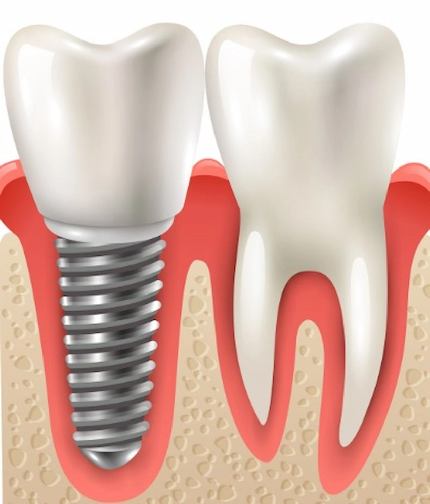 dental implant pain