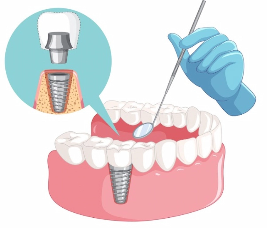 procedura di impianto dentale