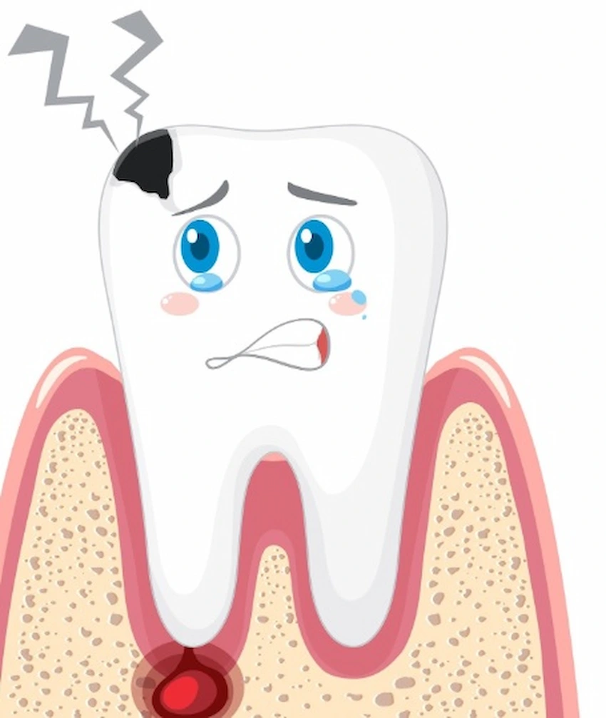 cracked teeth