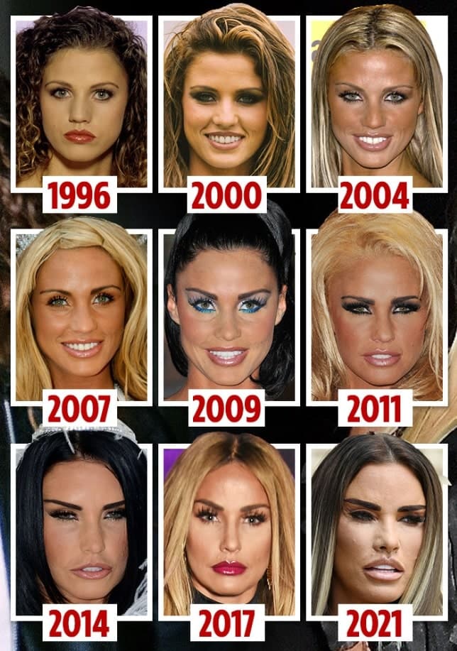 Katie Price New Teeth Turkey Przed I Po Lic wkach LEMA