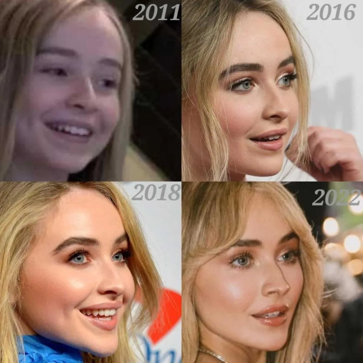 Sabrina-Carpenter-New-Teeth-New-Dental-2