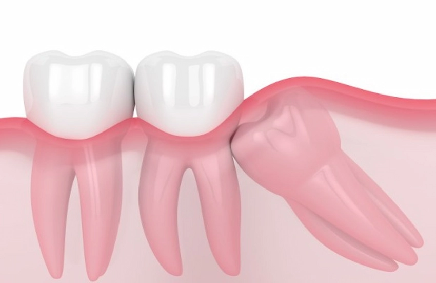 crescita dei denti del giudizio