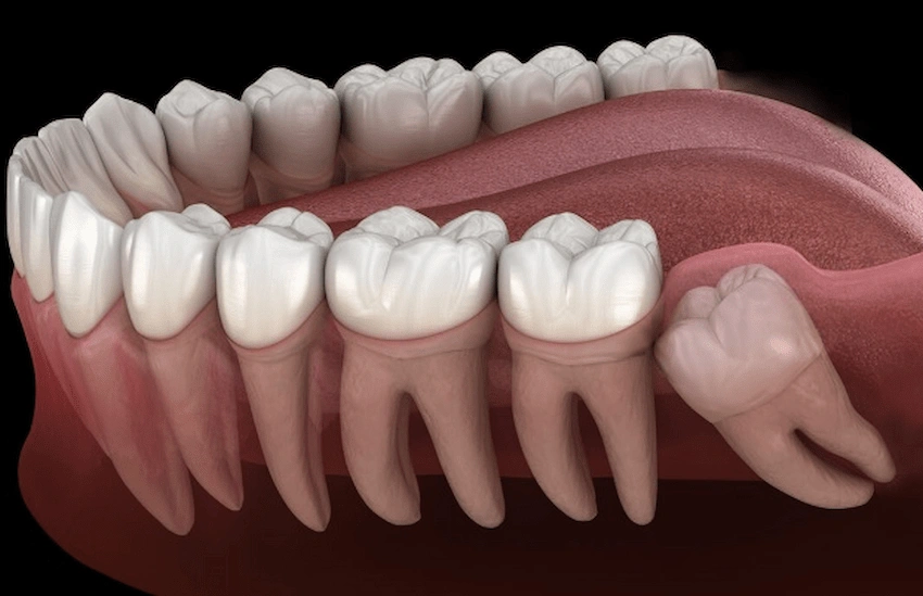 chirurgia dei denti del giudizio