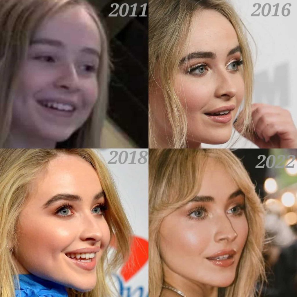 Sabrina-carpenter-new-theeth-new-dental-2