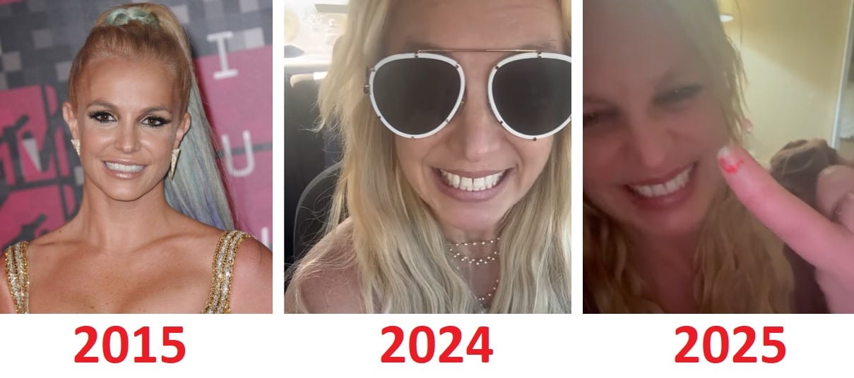 bretney spears teeth before and after