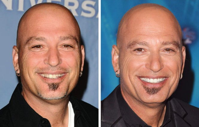howie mandel before after