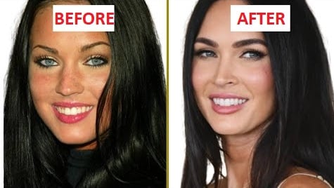 megan fox teeth implant before and after 2025