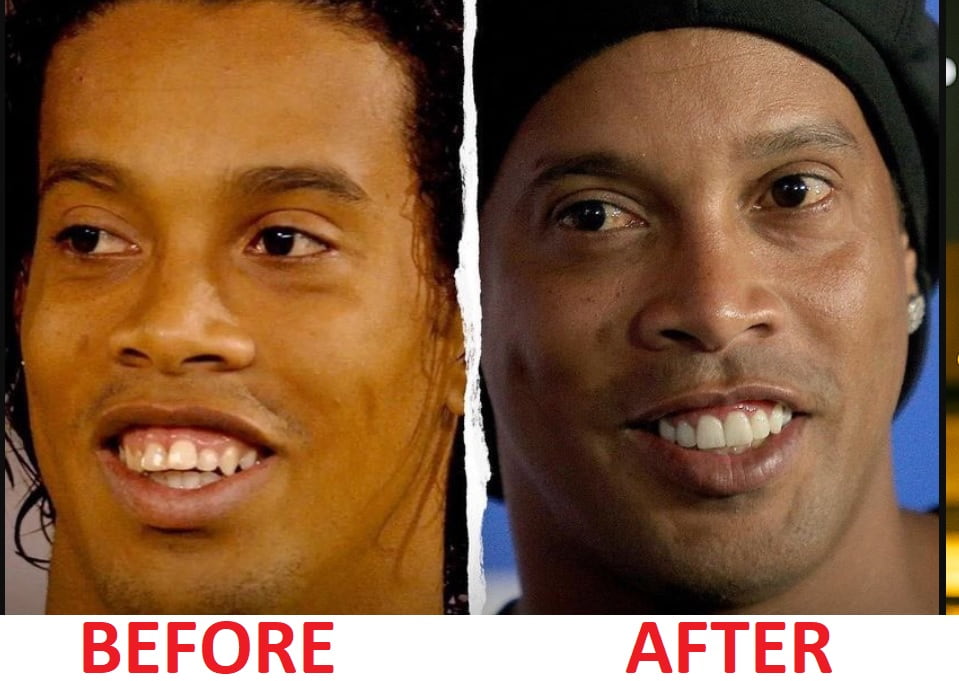 ronaldinho teeth before and after