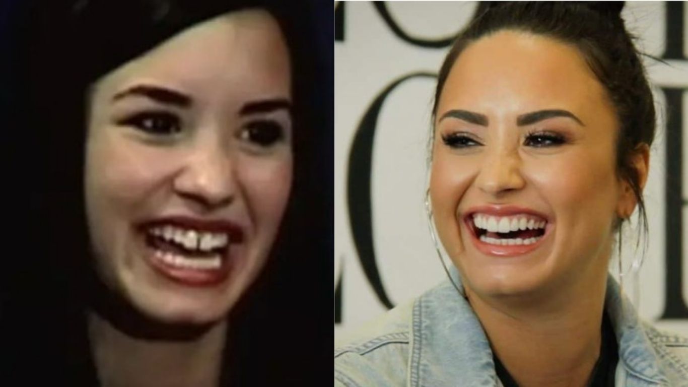 demi lovato teeth before after