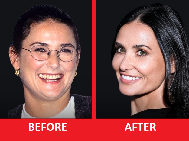 demi moore teeth before after