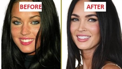 megan fox teeth implant before and after 2025