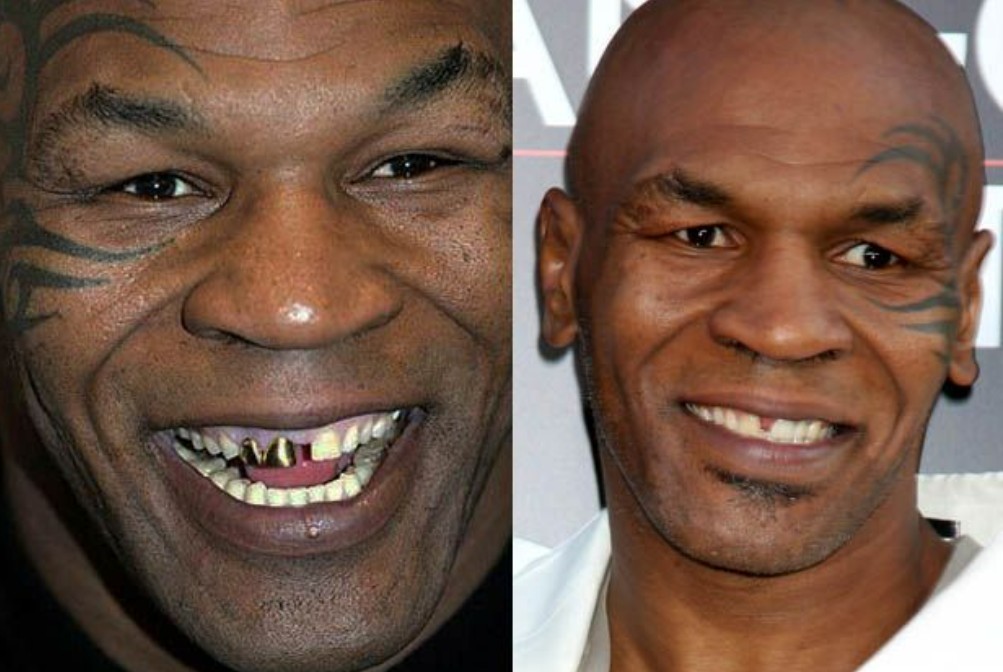 mike tyson teeth before after