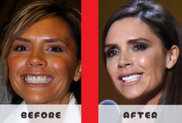 victoria beckham teeth before and after
