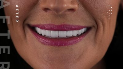 zygomatic implants before after 10