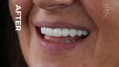 zygomatic implants before after 2
