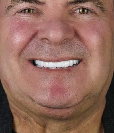 zygomatic implants before after 4
