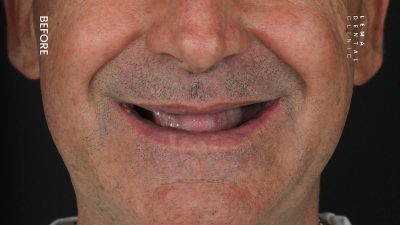 zygomatic implants before after 5