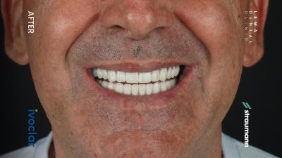 zygomatic implants before after 6