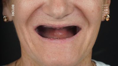 zygomatic implants before after 7
