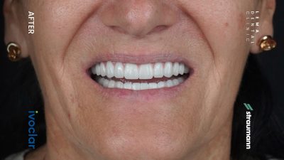 zygomatic implants before after 8