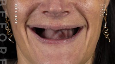 zygomatic implants before after 9