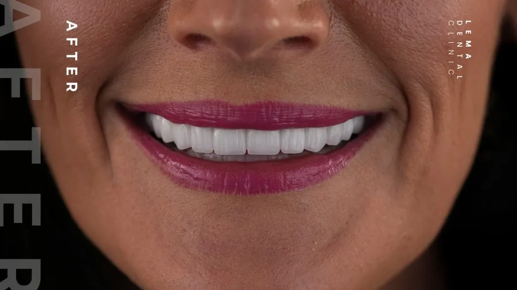 zygomatic implants before after 10