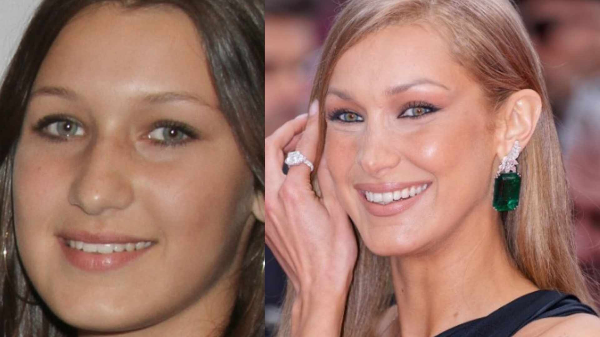 bella hadid teeth before after