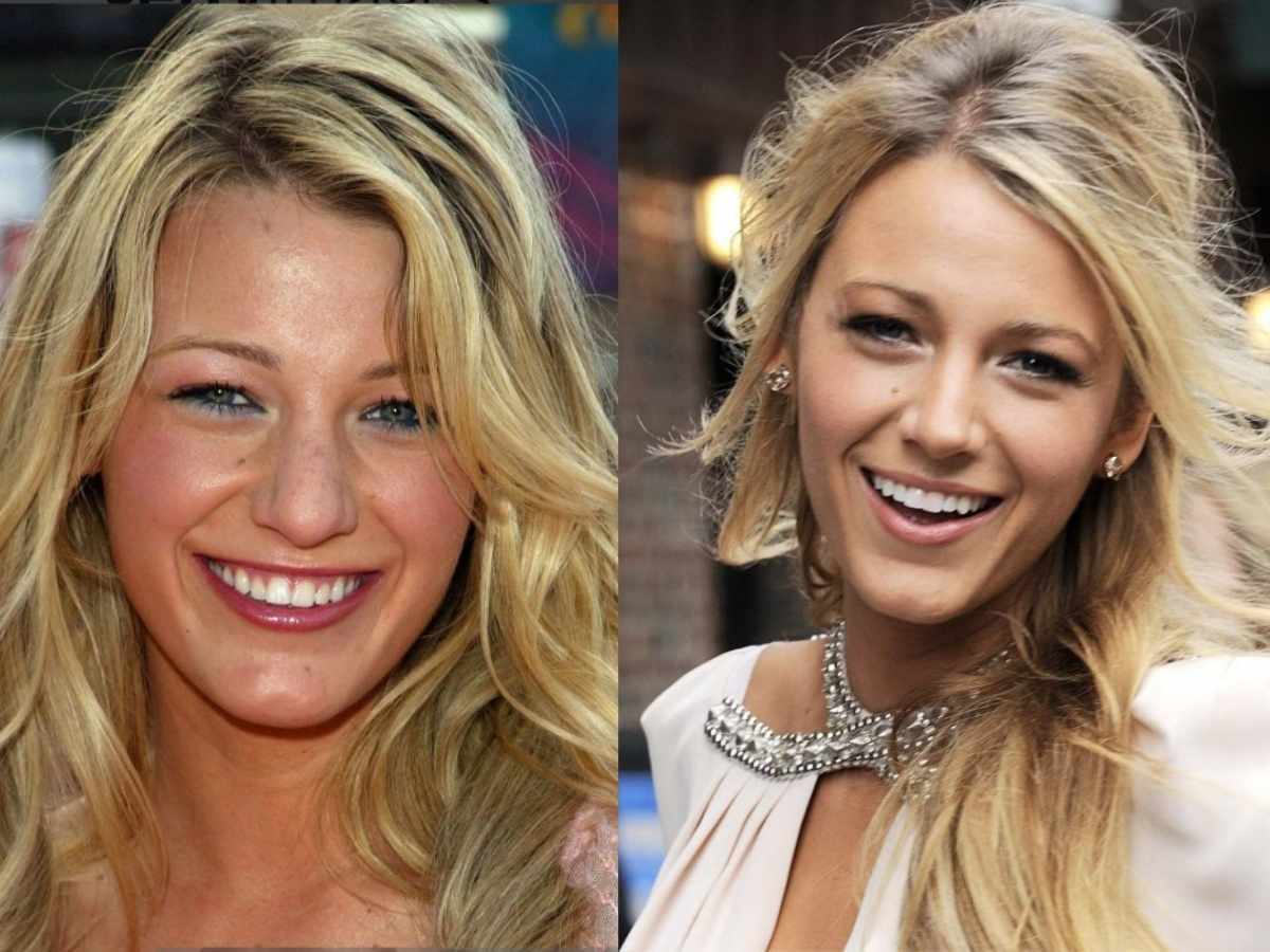 Blake Lively's Porcelain Veneers Before and After