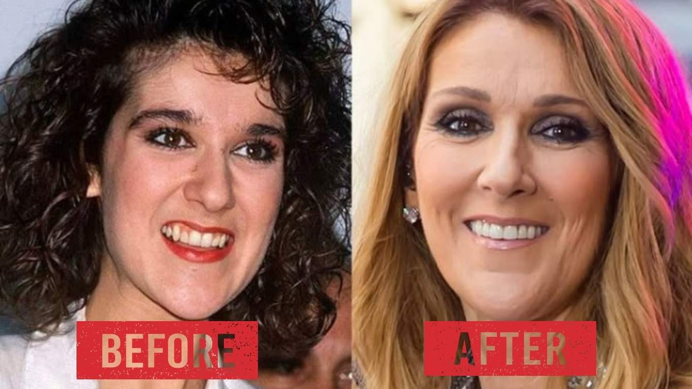 celine dion teeth before after