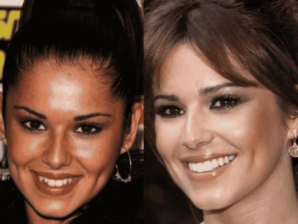 cheryl cole teeth before after cheryl cole teeth before after