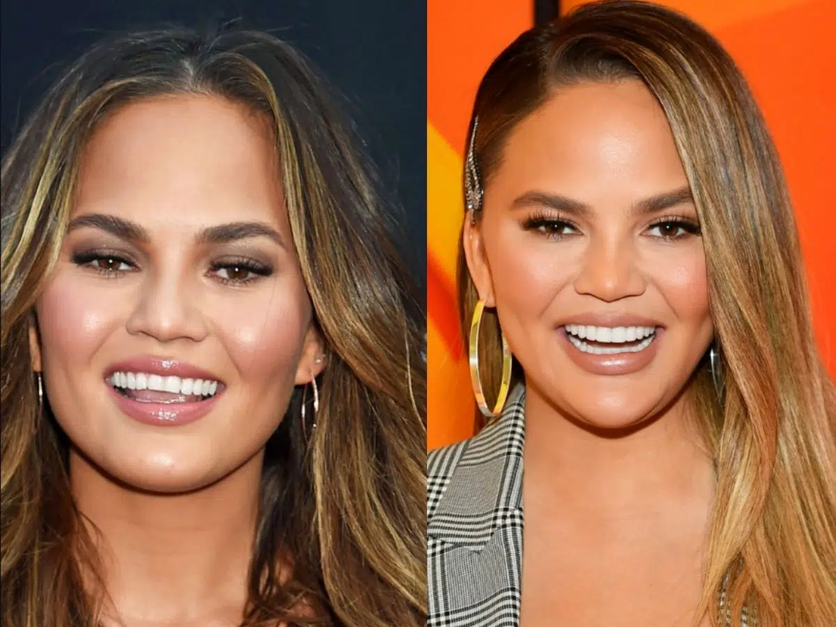 chrissy teigen teeth before after