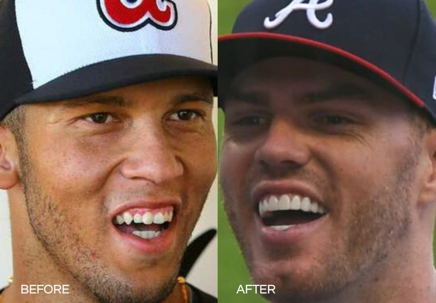 freddie freeman teeth before after