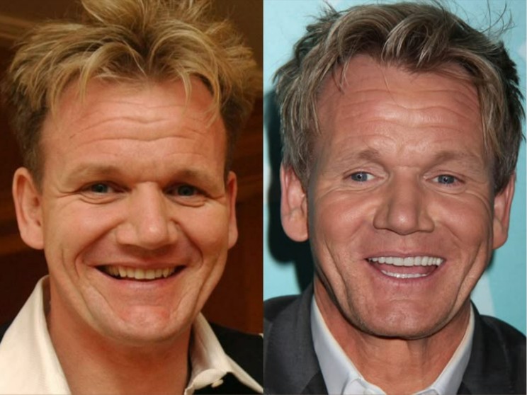 gordon ramsay teeth before after