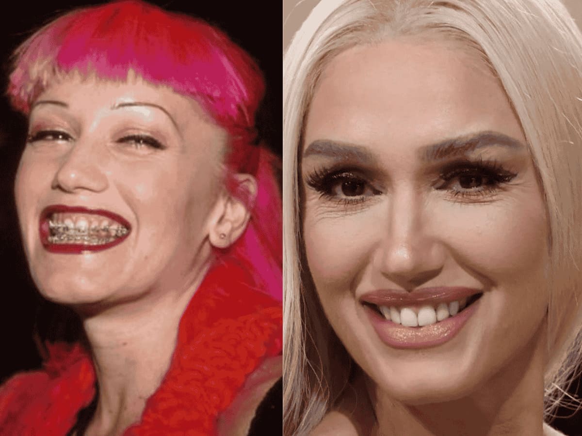gwen stefani teeth before after