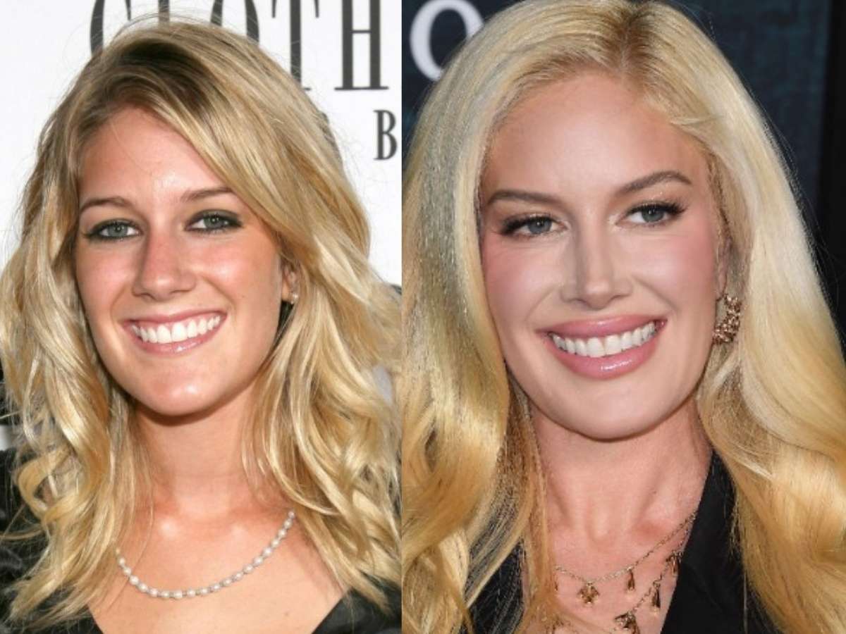 heidi montag teeth before after