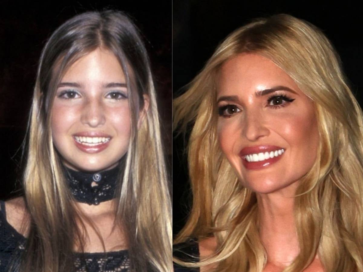 ivanka trump teeth before after