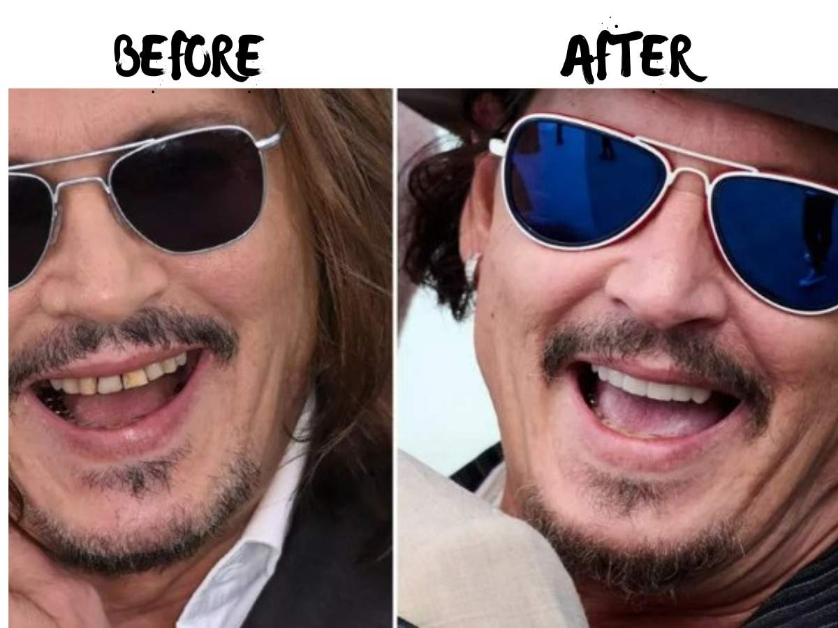 johnny depp teeth before after