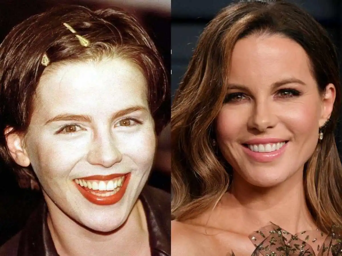 Dinții noi ai lui Kate Beckinsale acum: Înainte și după fațete