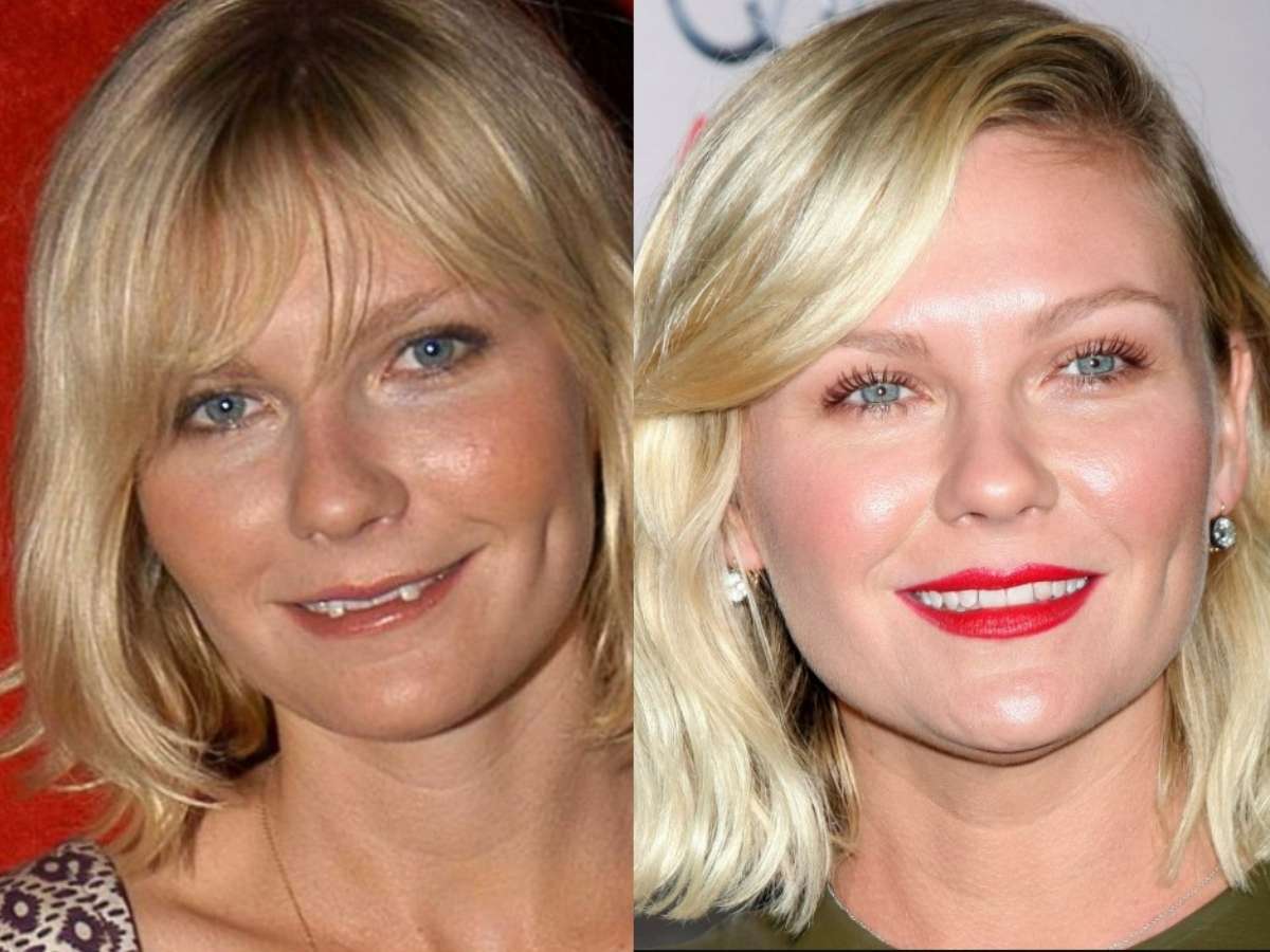 kirsten dunts teeth before after