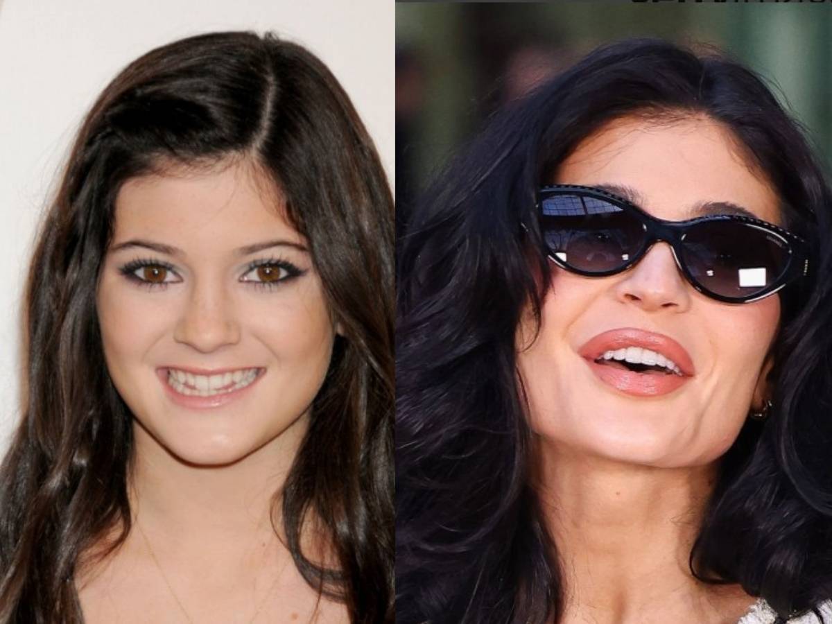 kylie jenner teeth before after