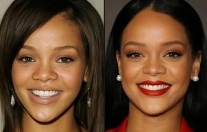 rihanna teeth before and after