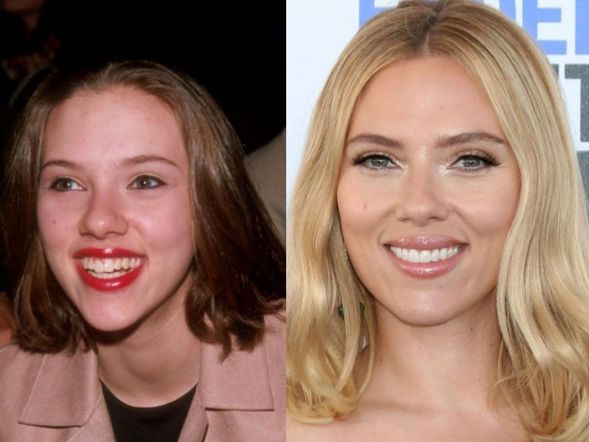 scarlett johansson teeth before after