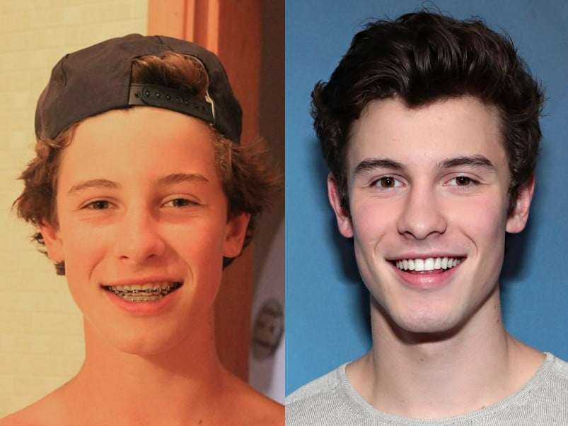 shawn mendes teeth before after (2)