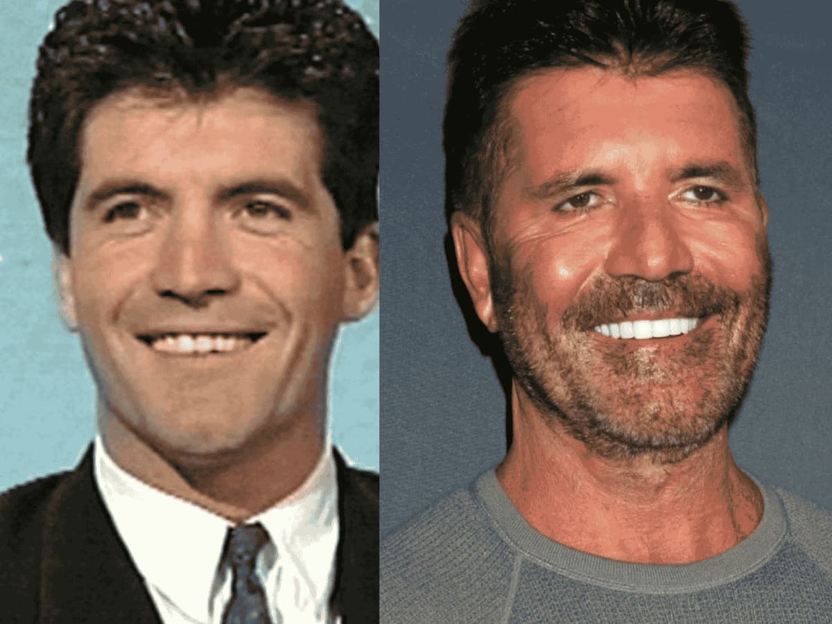 Simon Cowell'un Hollywood Gülüşü: Kaplamalar Onu Nasıl Değiştirdi