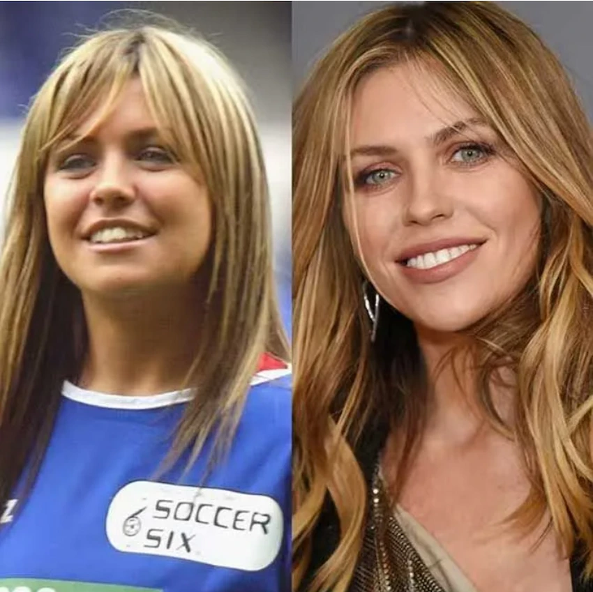 abbey clancy teeth before after