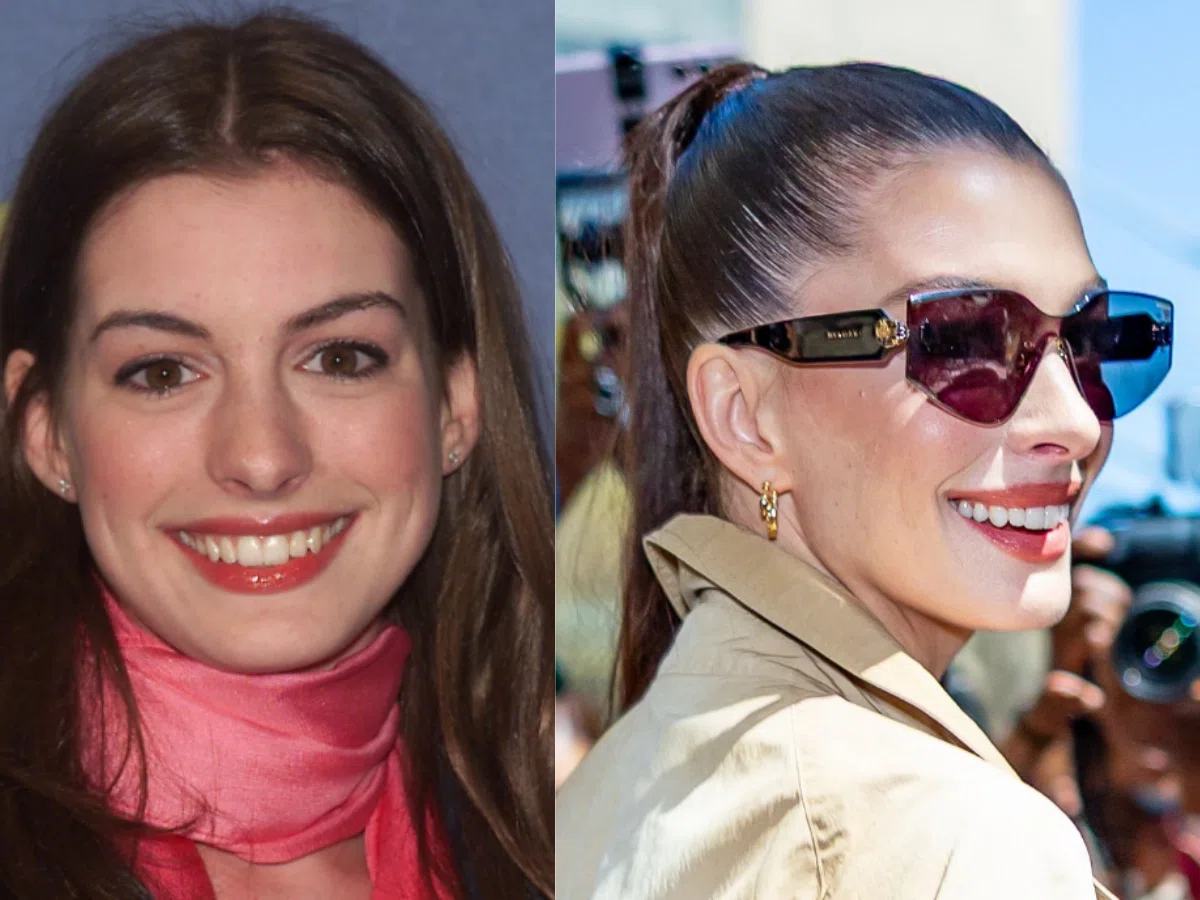anne hathaway teeth before after