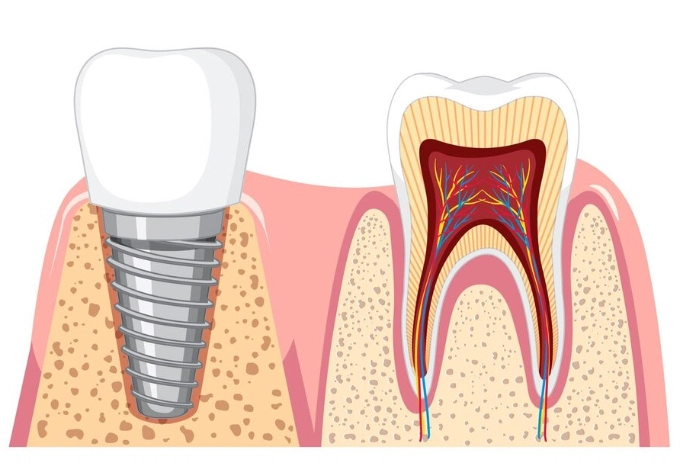 are Euroteknika dental implants dental products strong safe